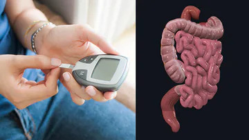 SGLT2 Inhibitors in Type 2 Diabetes Linked to Lower Risk of Developing GI Cancers