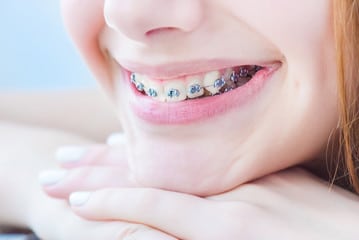 9 Tips to Make Oral Hygiene for Braces Wearers Easier