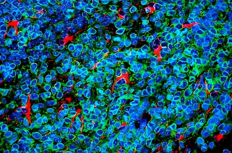 Lung cancer cells covertly thrive in brain under guise of protection, study finds 