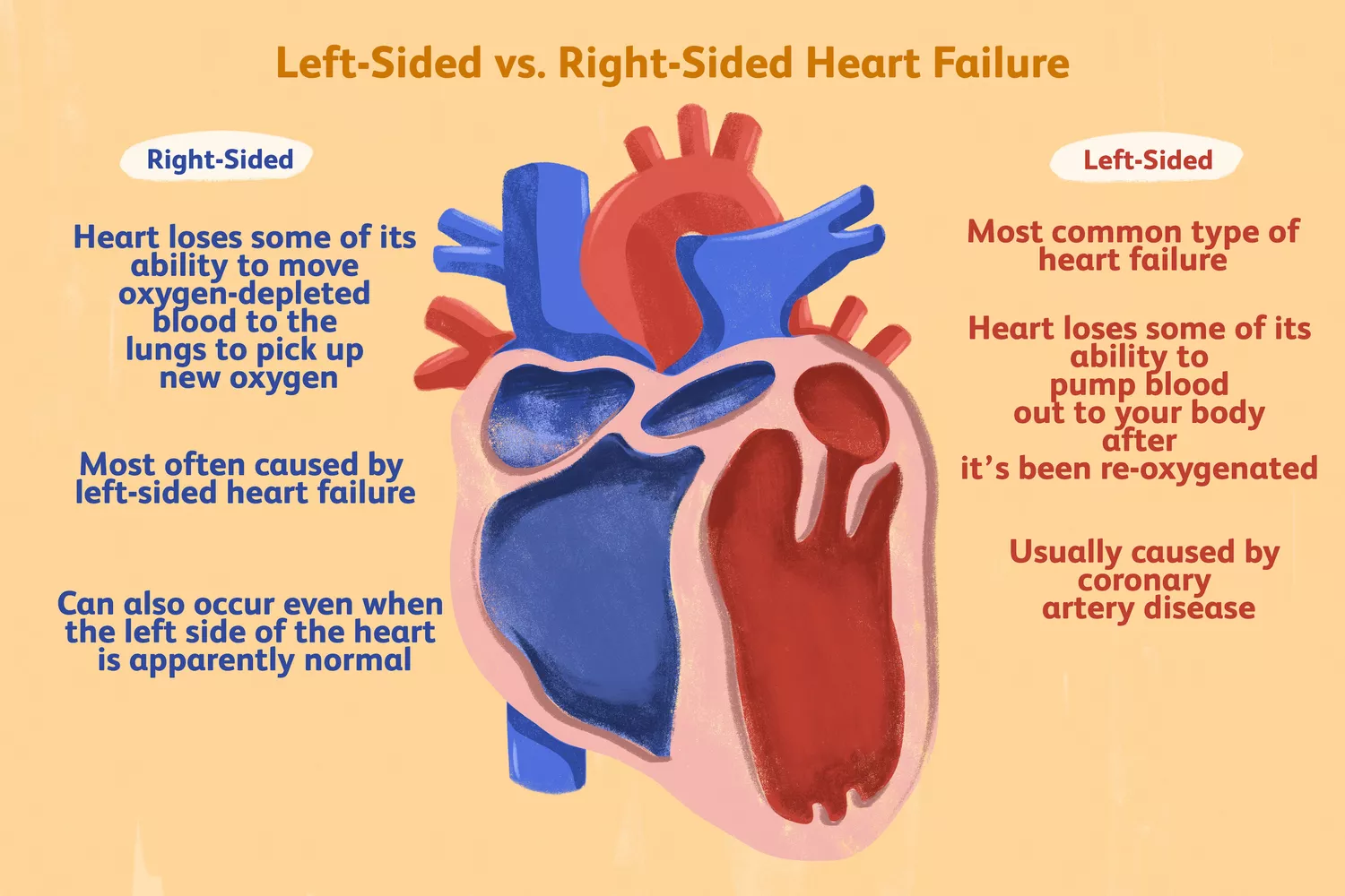 Left- vs. Right-Sided Heart Failure: Know the Differences