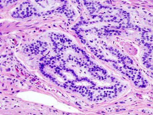 Study finds colon cancer driven by hereditary gene mutations in 1 in 6 patients 