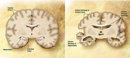 Alzheimer's researchers find clues to toxic forms of amyloid beta 