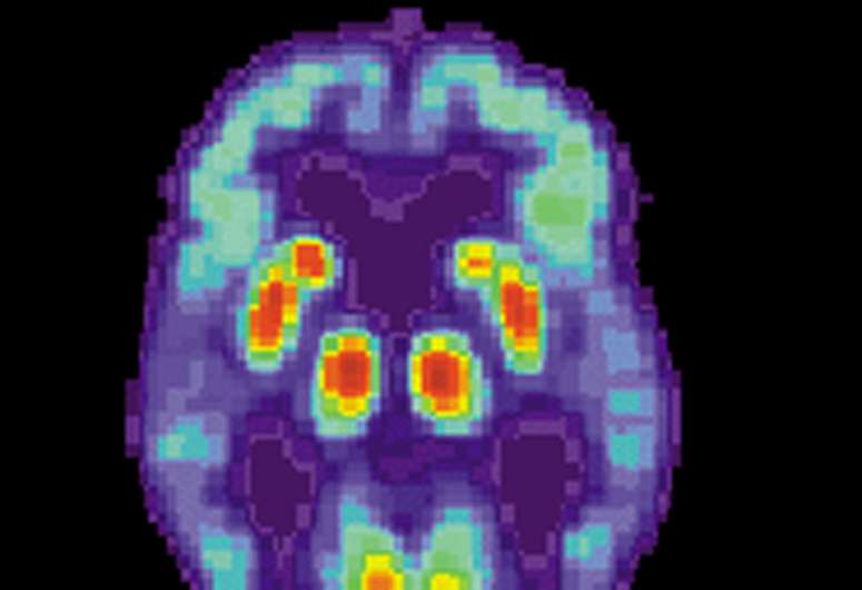 Immune system dysfunction may occur early in Alzheimer's disease 