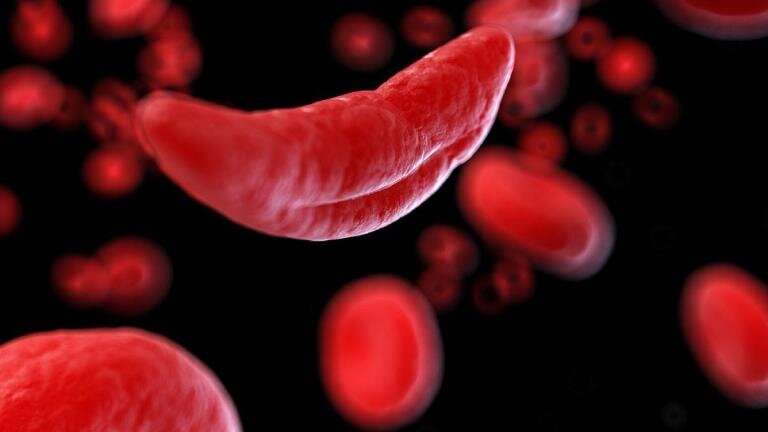 Researchers identify safety of a potential new treatment to manage complications from sickle cell disease