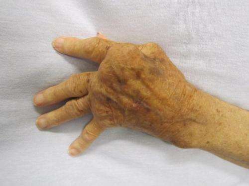 Study shows vagus nerve stimulation significantly reduces rheumatoid arthritis symptoms 