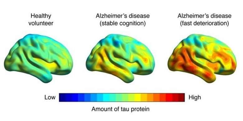 Brain imaging can predict Alzheimer's-related memory loss 