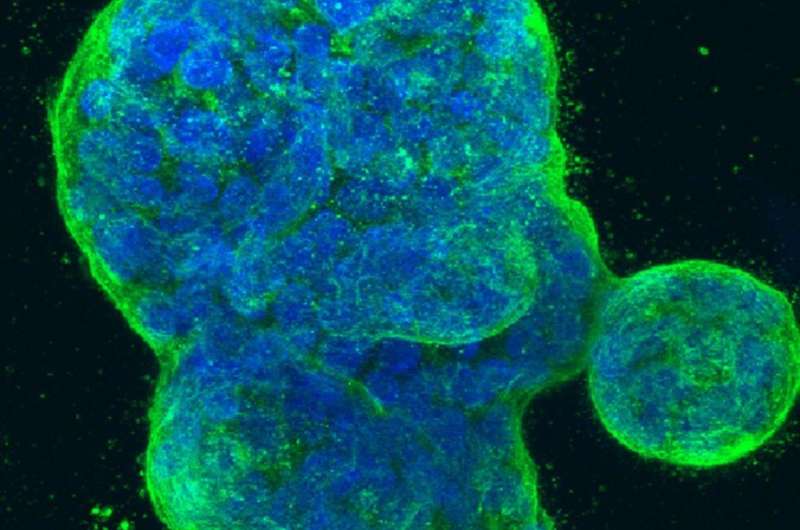 Mechanism of a breast cancer drug points to a possible new therapy 